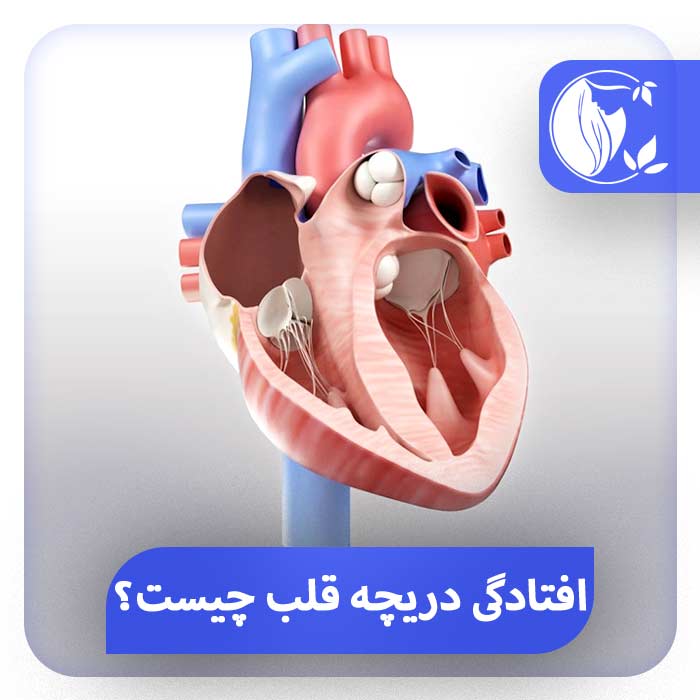 افتادگی دریچه قلب