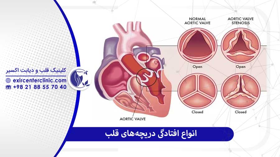 انواع افتادگی دریچه‌ قلب