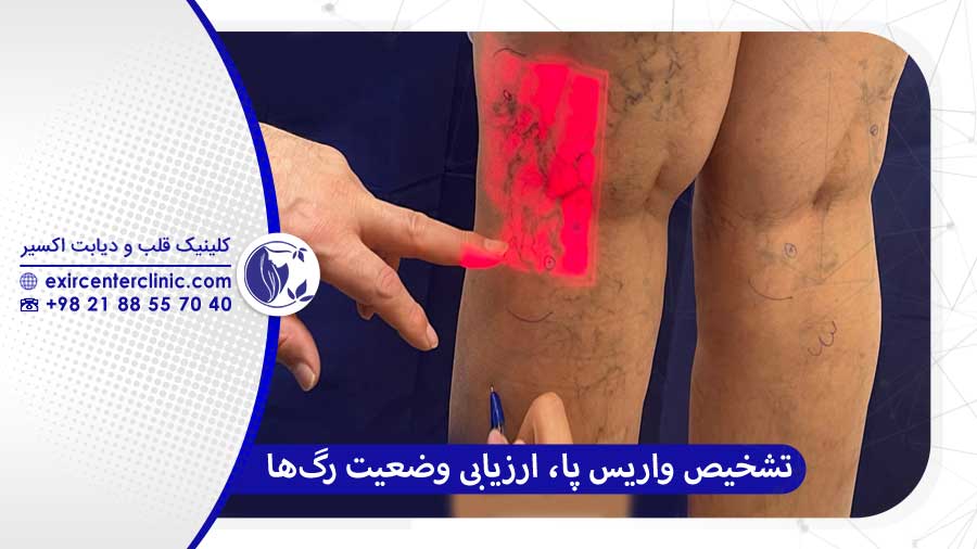 تشخیص واریس پا