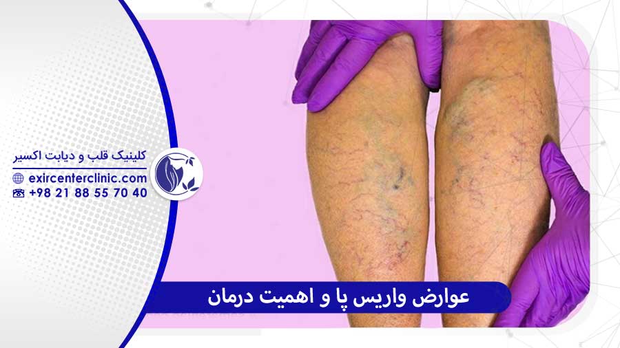 عوارض واریس پا چرا درمان اهمیت دارد؟