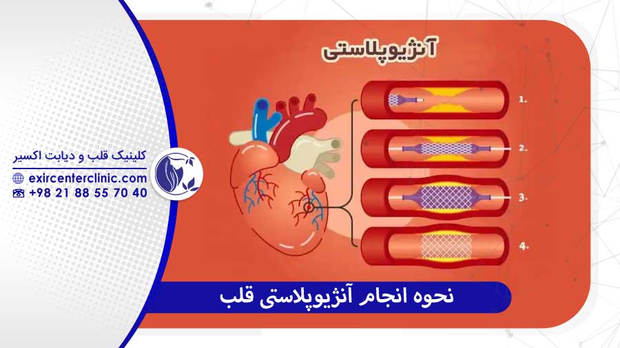 مراقبت‌های بعد از آنژیوپلاستی قلب